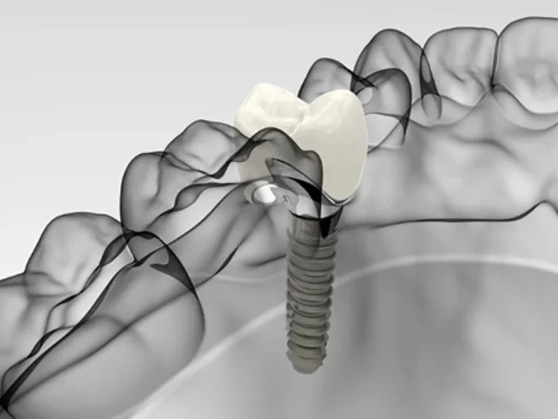 Centrodent - slika 5
